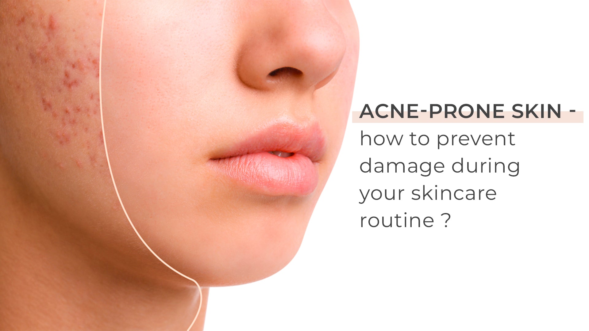 Acne-prone skin? How to prevent damage during your skincare routine