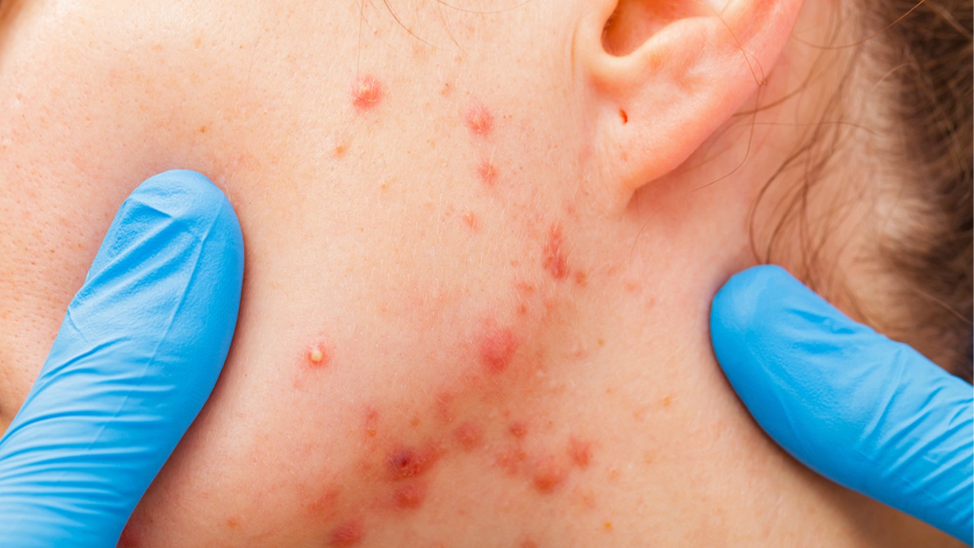 Acne Spot Treatment serum