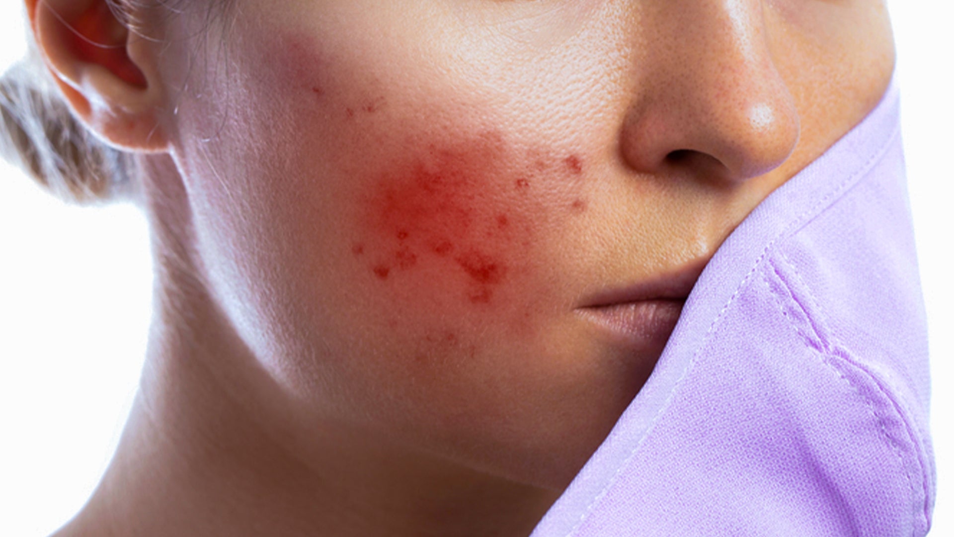 Calm you angry irritated acne in 3 steps