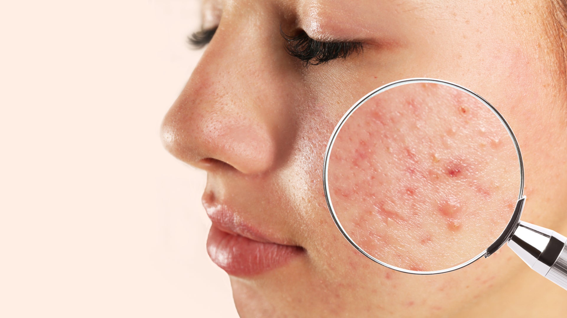 Acne Solutions