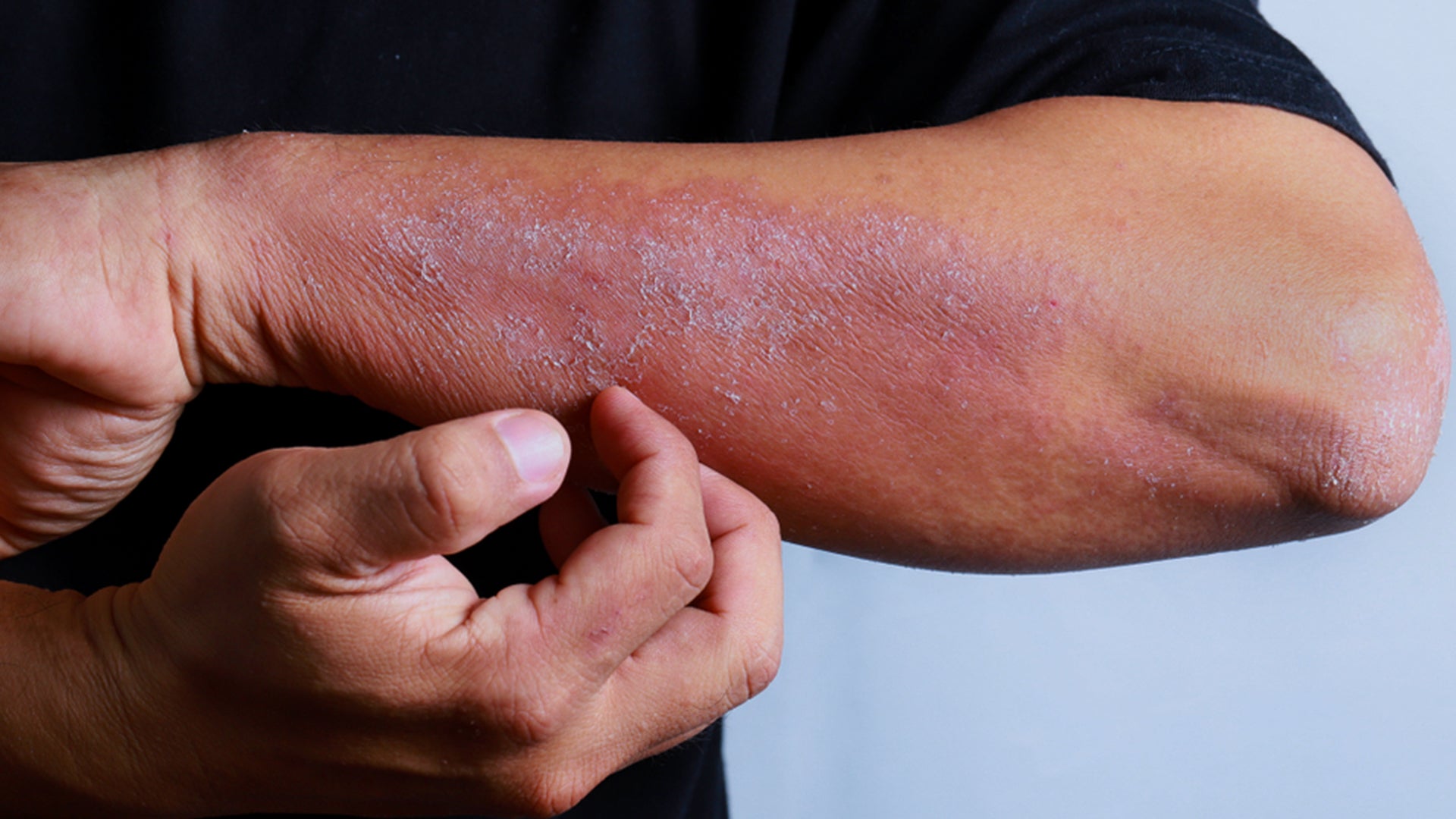 Allergic Reaction of skin - suganda