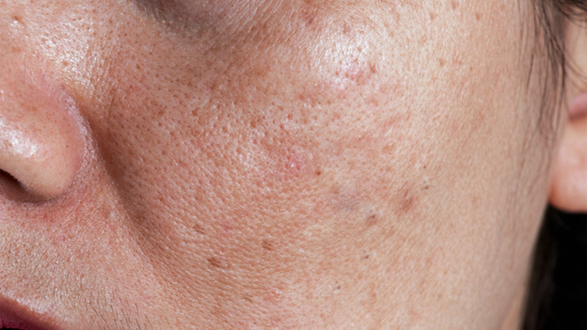 acne and pigmentation for combination skin
