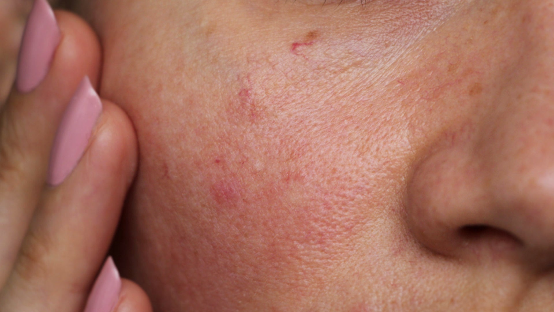 Acne sensitive skin