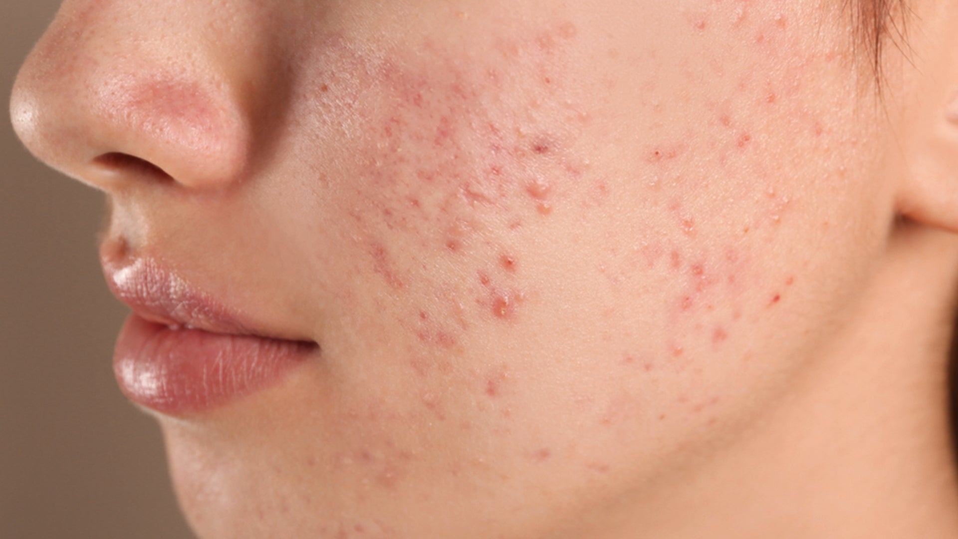 Salicylic acid serum for acne