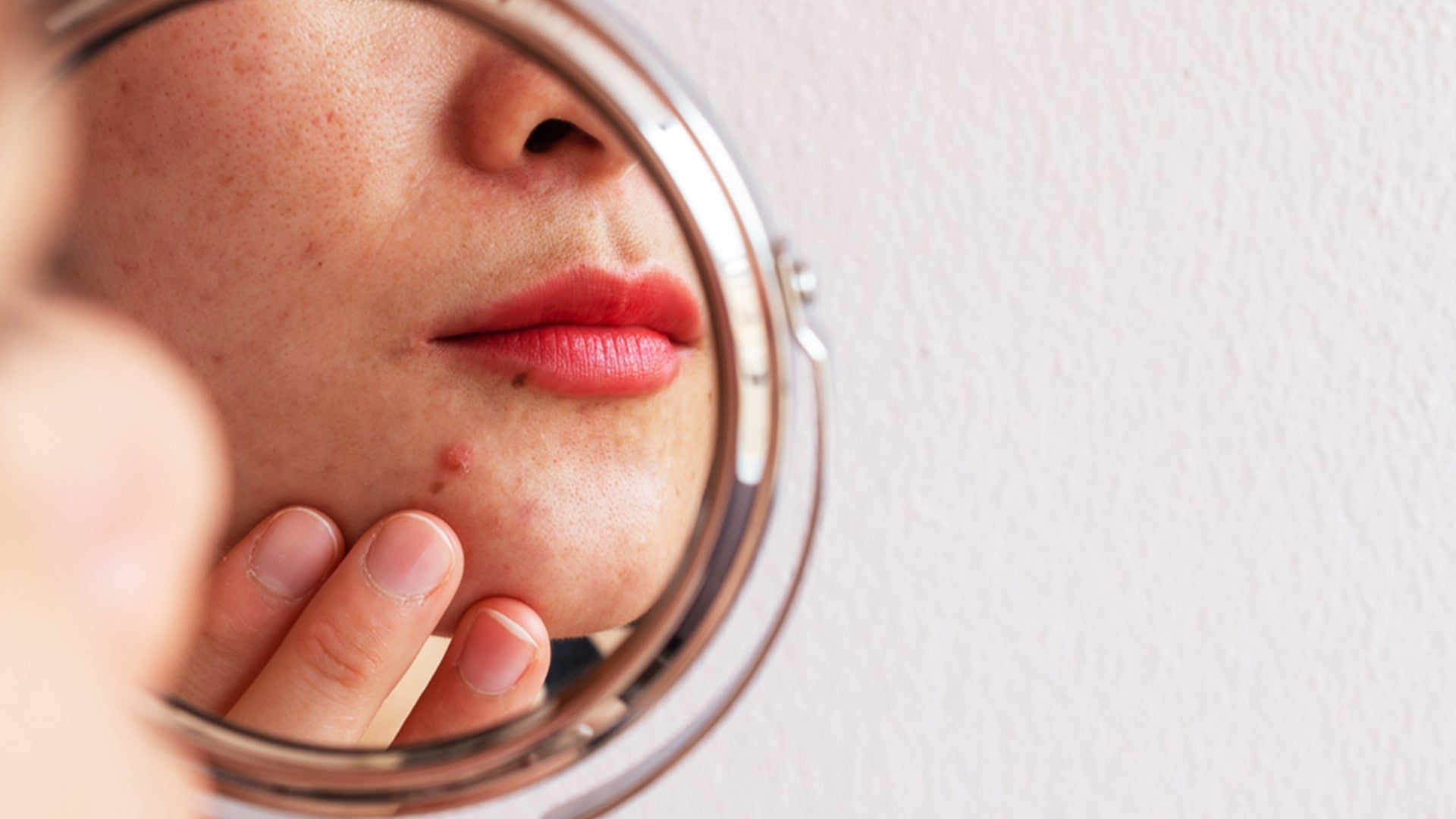 Treatment of acne