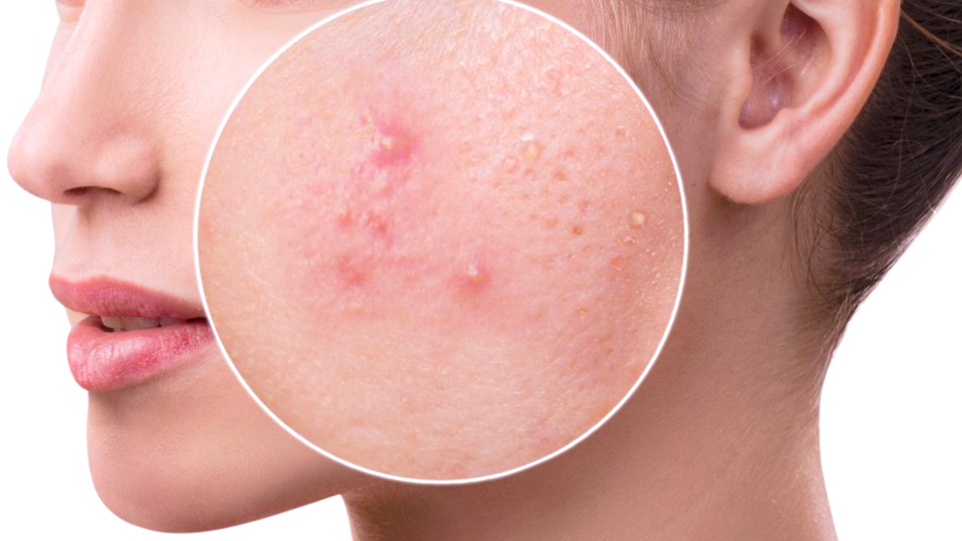 acne cause allergic reactions