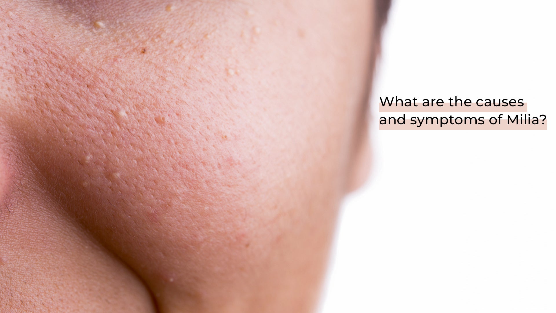 acne causes, symptoms, and treatment