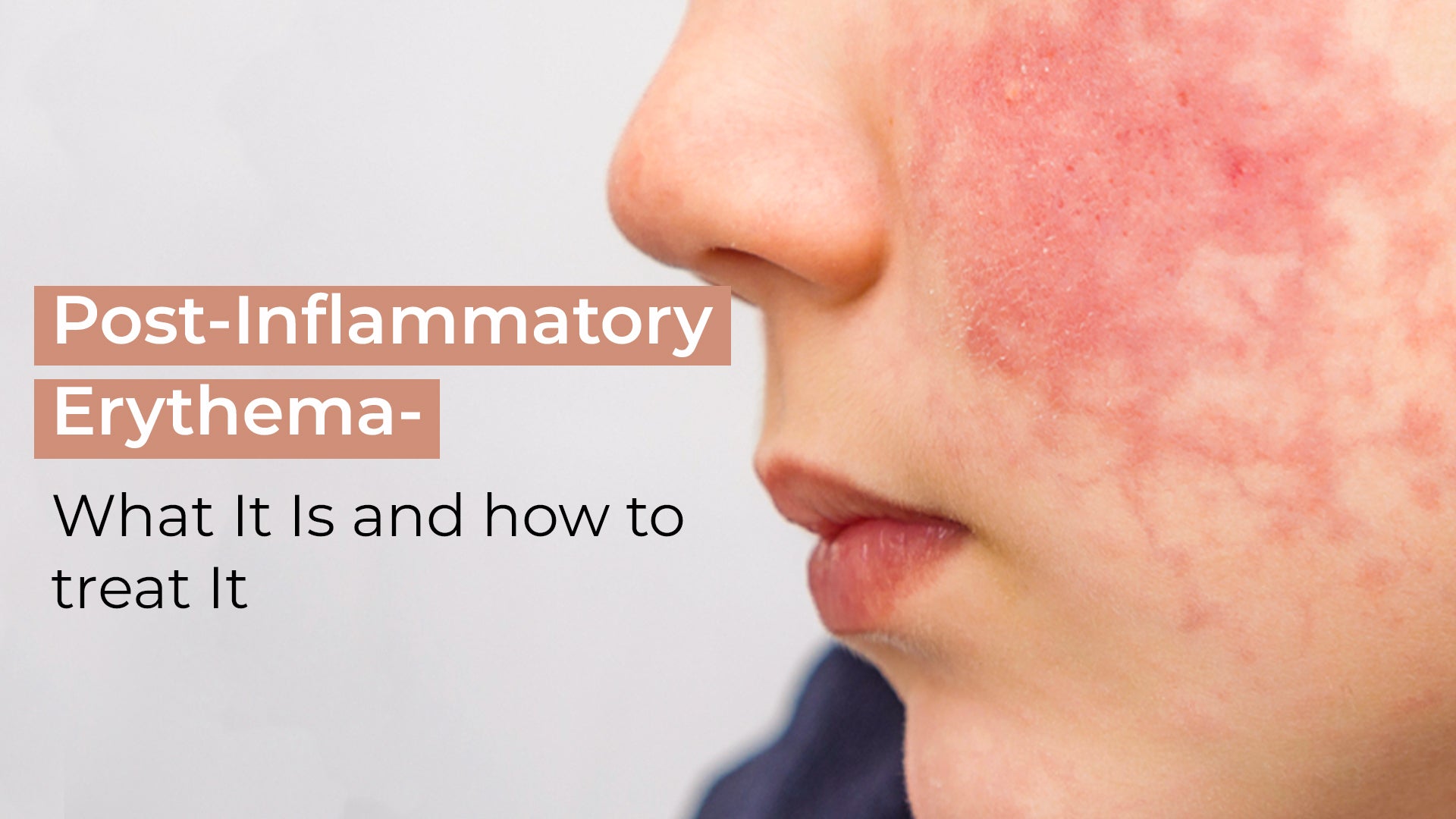 Post-Inflammatory Erythema: What It Is and How to Treat It