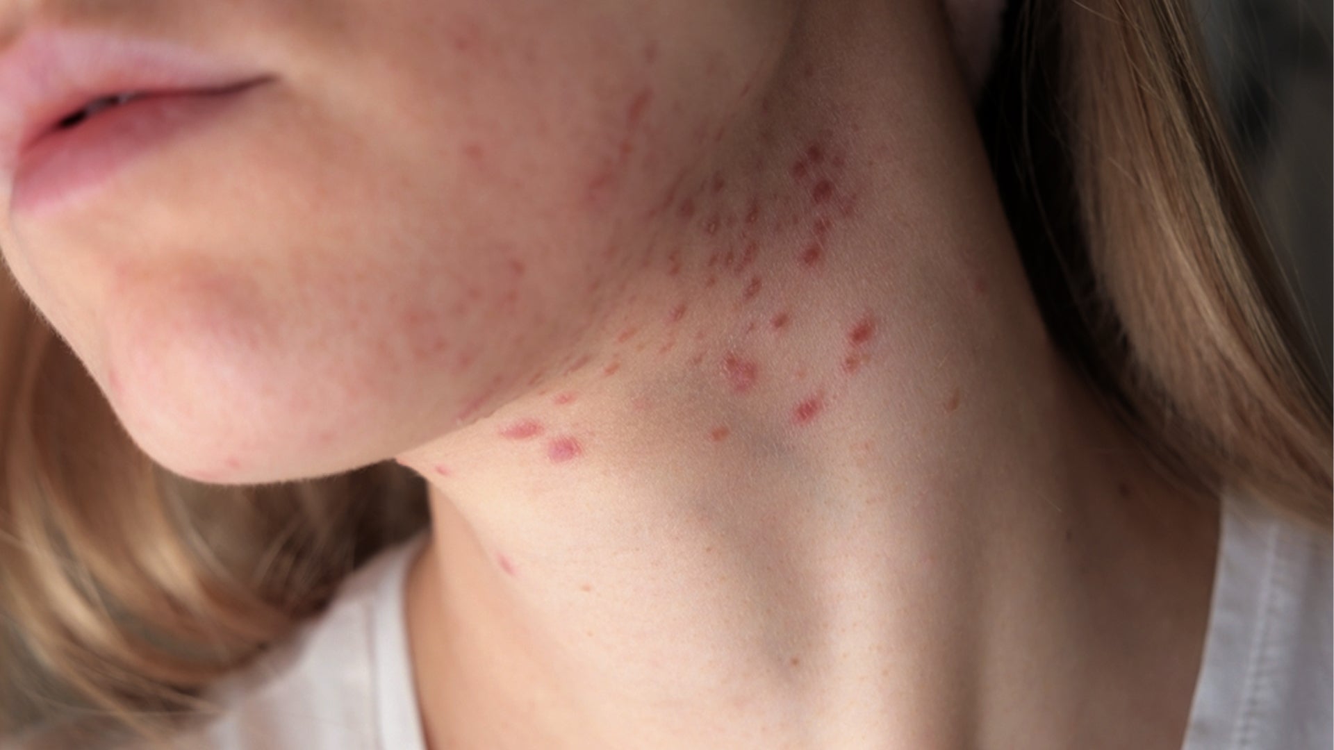 Retinol serum for acne