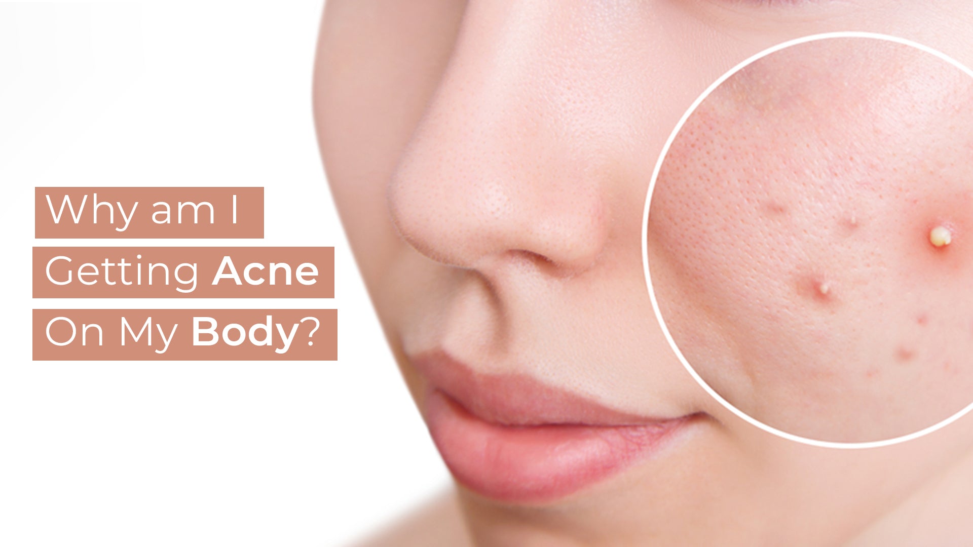 Reduce Facial Acne