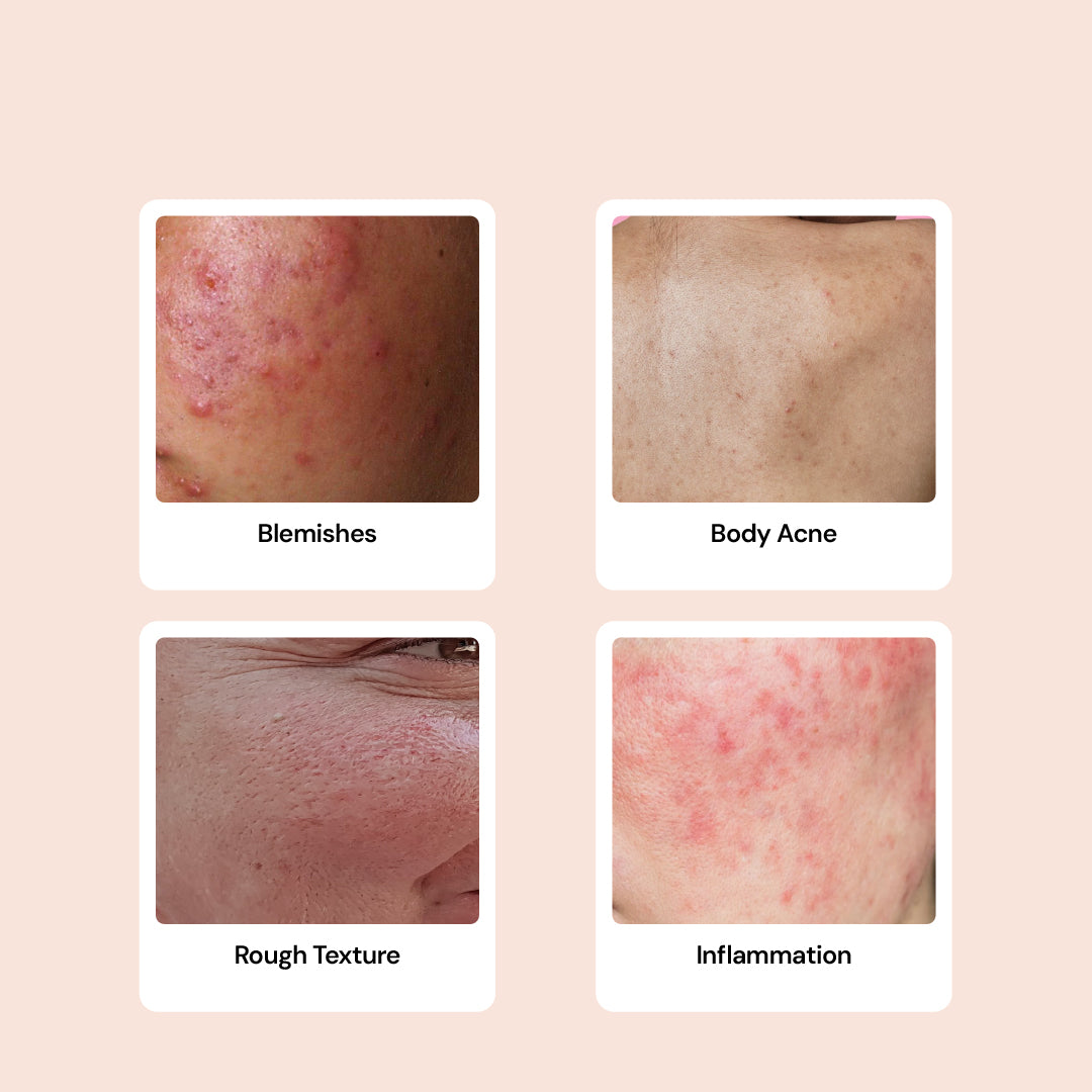 Salicylic Acid 2% Acne Body Spray - Back and Body Acne Mist