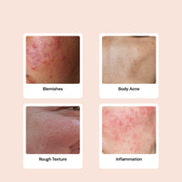 Thumbnail for Salicylic Acid 2% Acne Body Spray - Back and Body Acne Mist