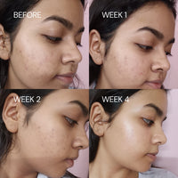 Thumbnail for Before and after skin treatment progress over four weeks on a person's face.