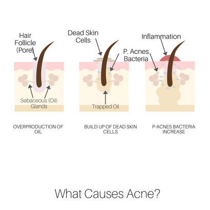 CAUSES OF ACNE - Suganda Skincare