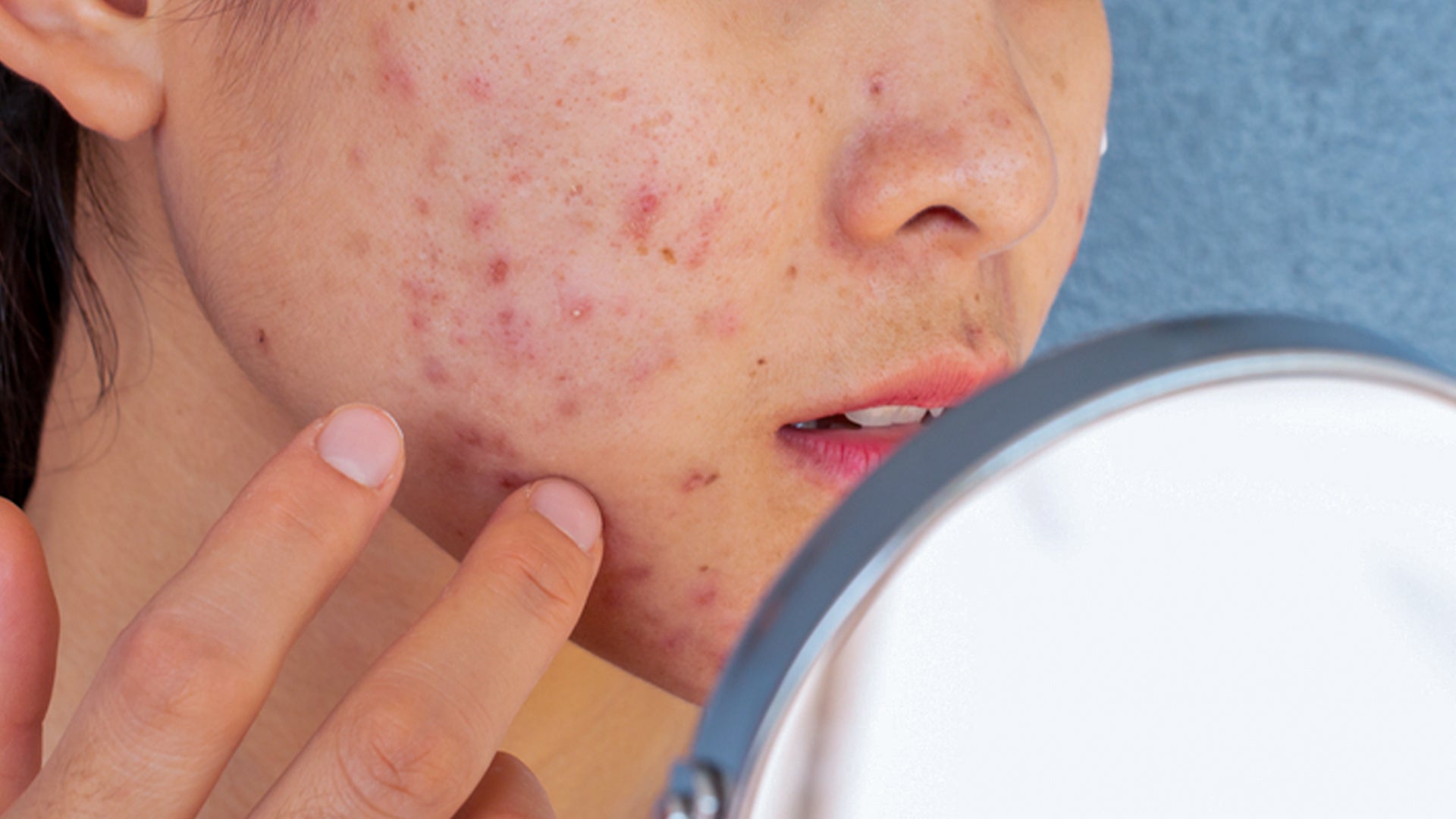 sensitive acne prone skin