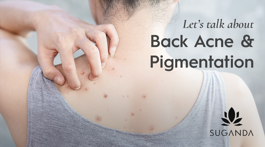 How to reduce Back acne & Back Pigmentation?