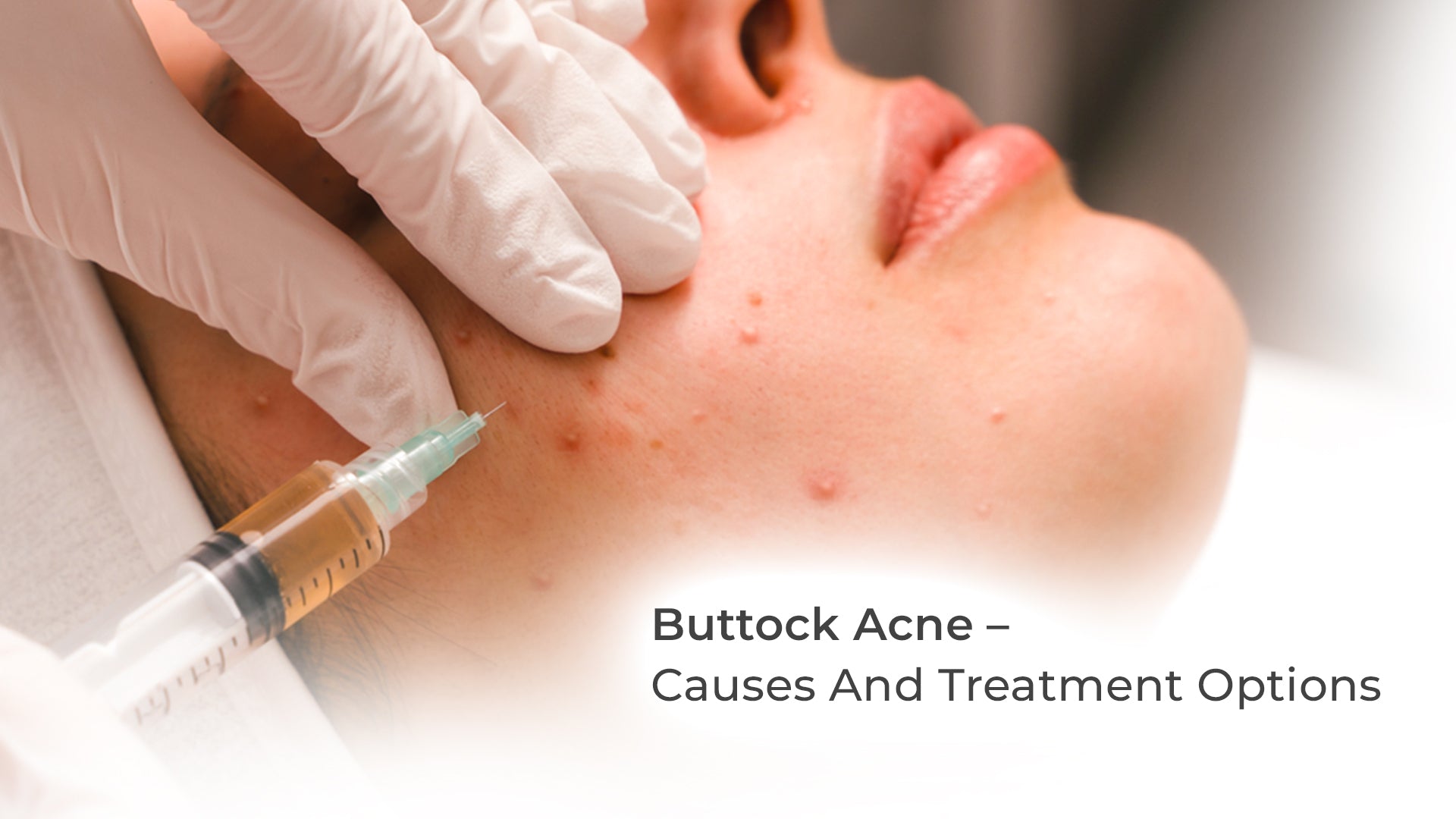 Buttock Acne – Causes And Treatment Options