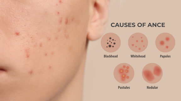 5 Types Of Acne You Should Know About 