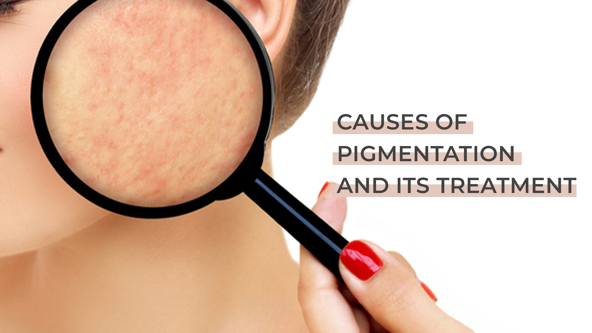 Causes of Pigmentation and its Treatment