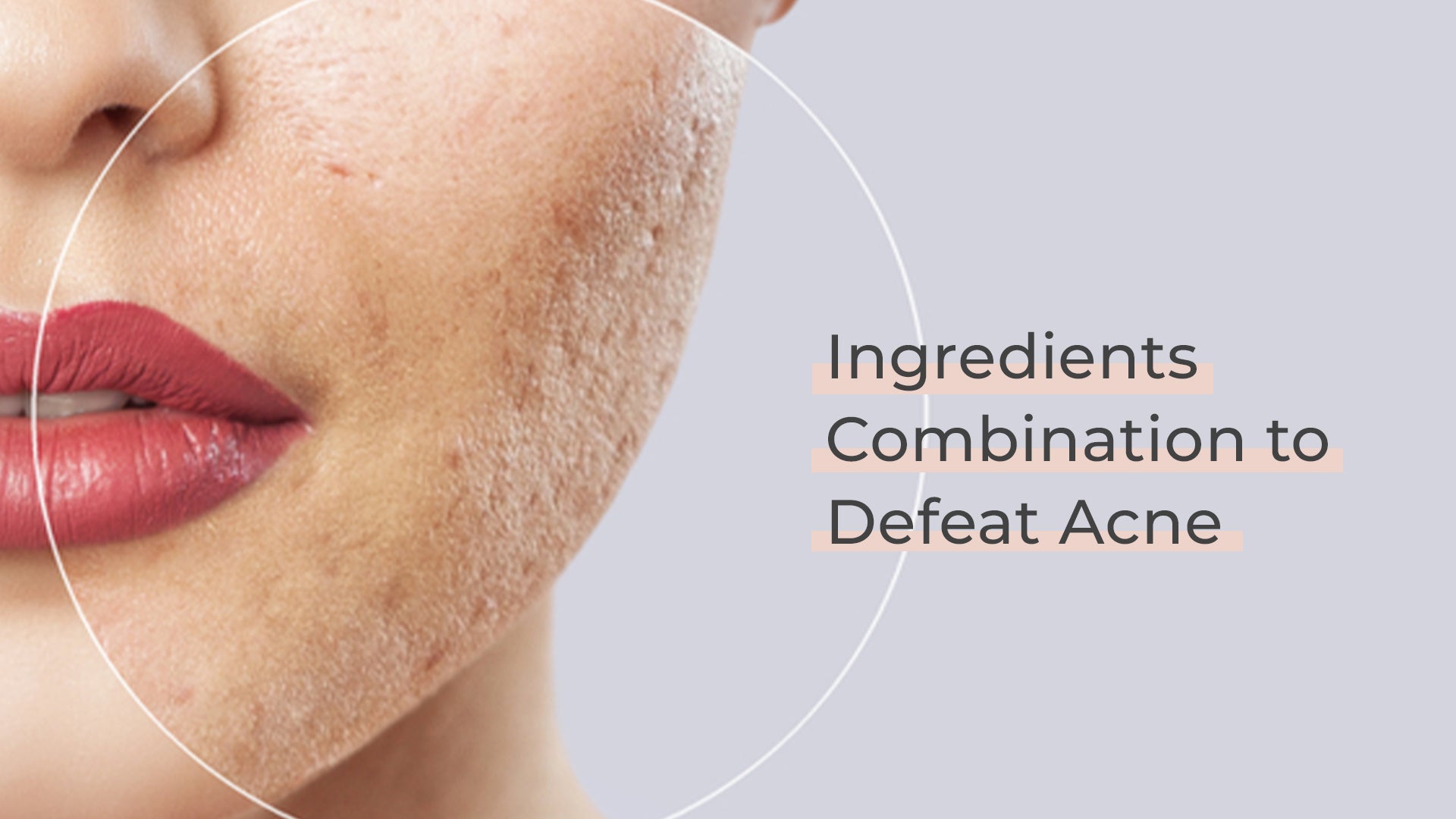 Five Ingredients Combination to Defeat Acne