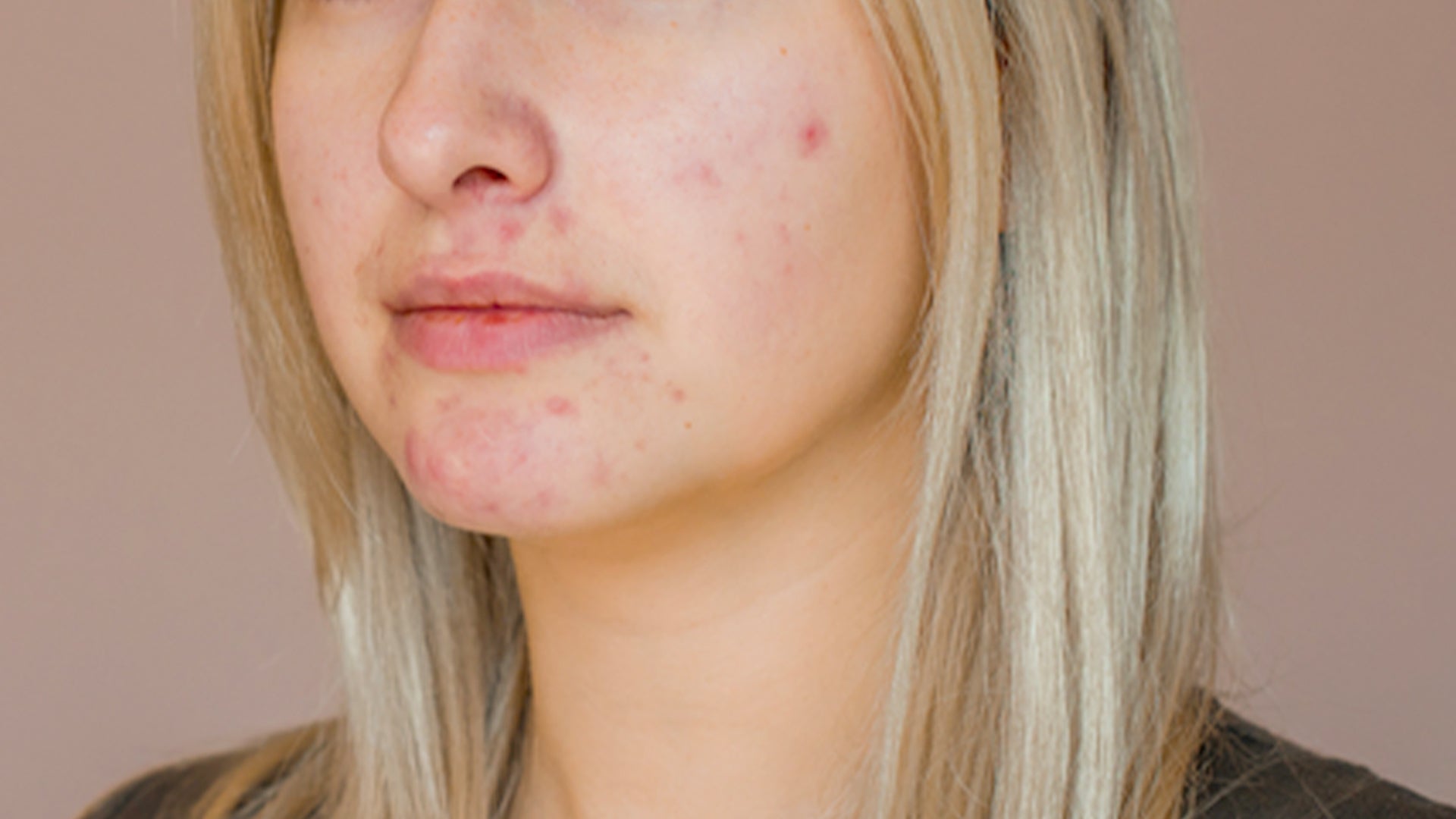 Foundation for acne prone skin