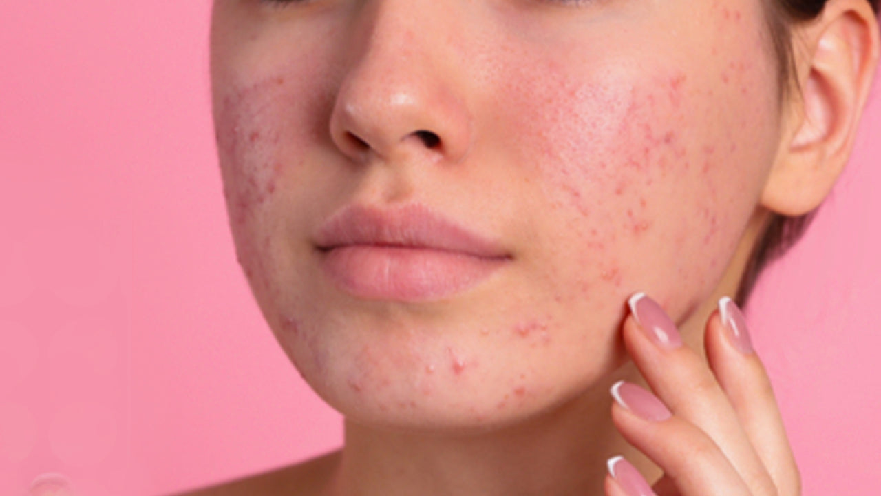 How To Get Rid Of Acne Scars | Retinoids for Acne | Vitamin c for Dark ...