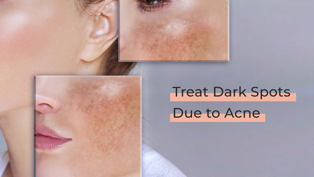 How to Treat Dark Spots Due to Acne? Face Cream & Serum for Acne Dark