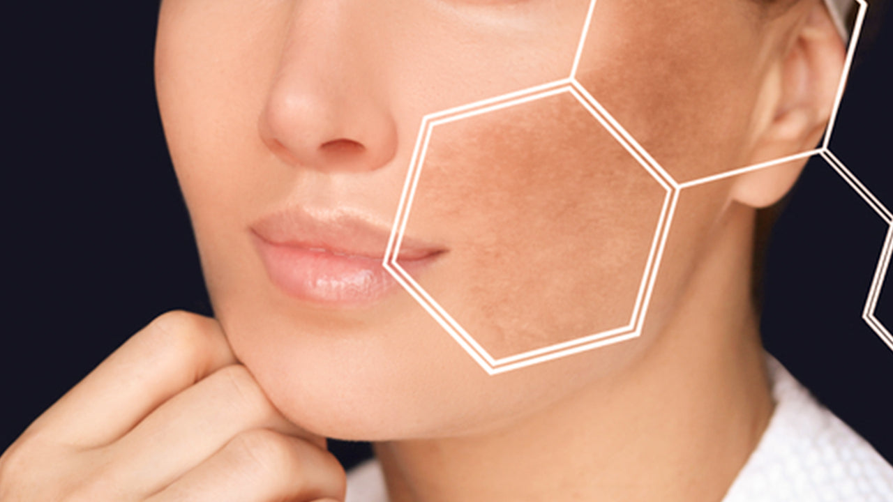 5 best Ingredients for Hyperpigmentation hyperpigmentation on face