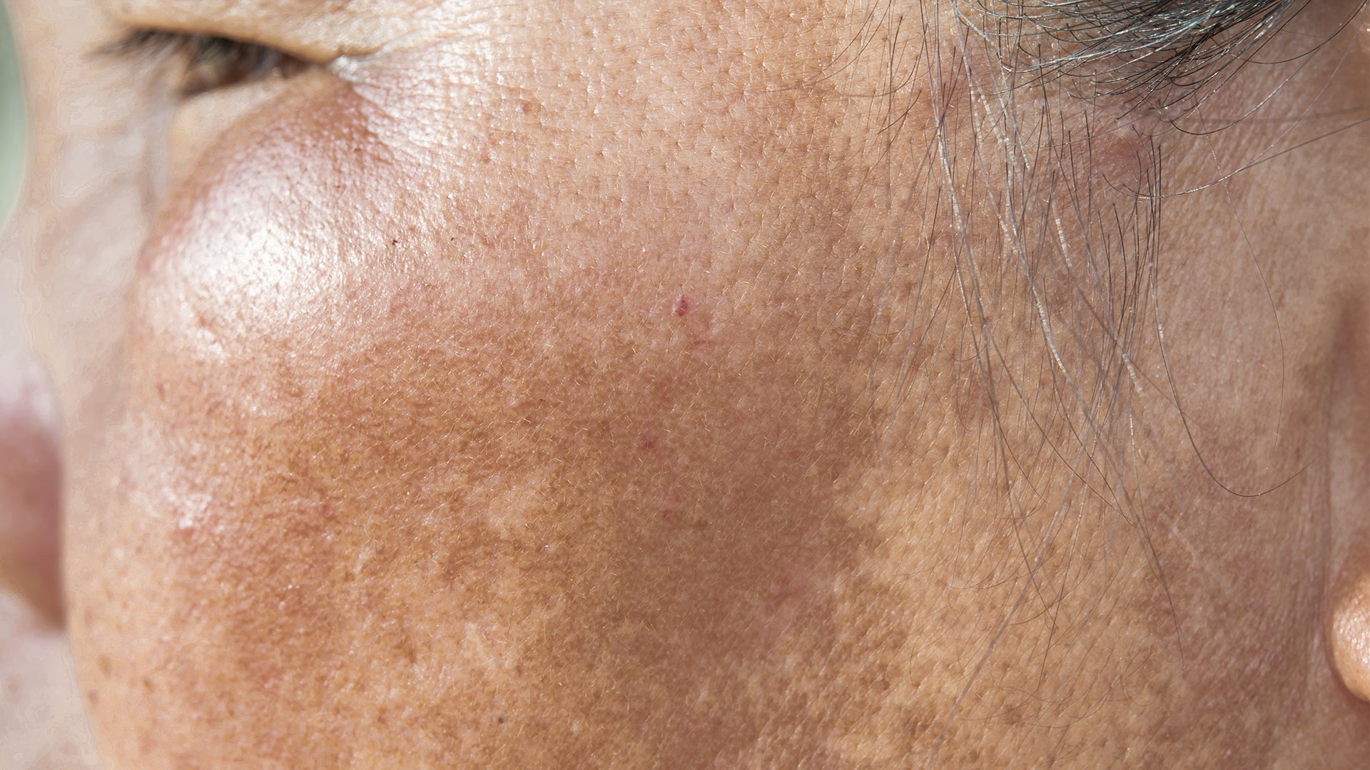 Melasma - Dark Patches on Your Skin