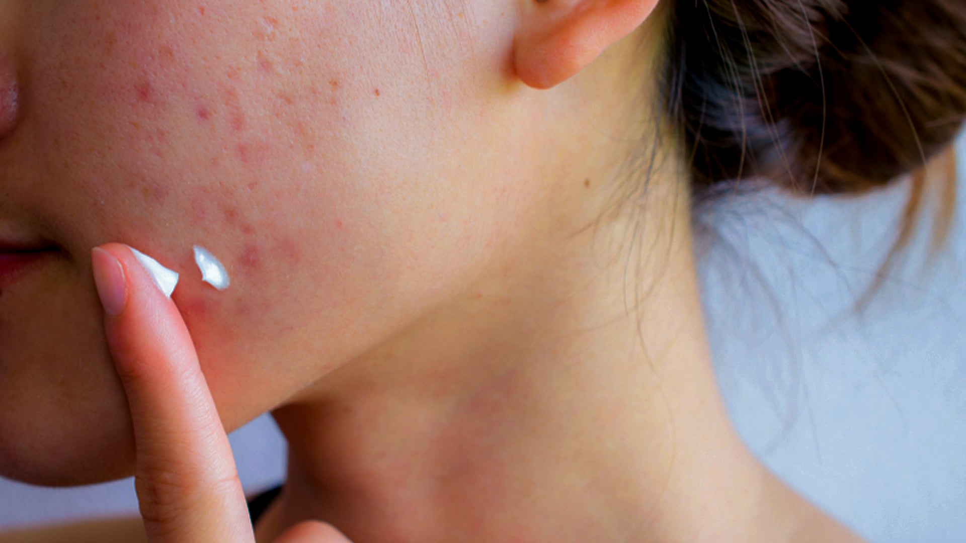 Moisture for acne