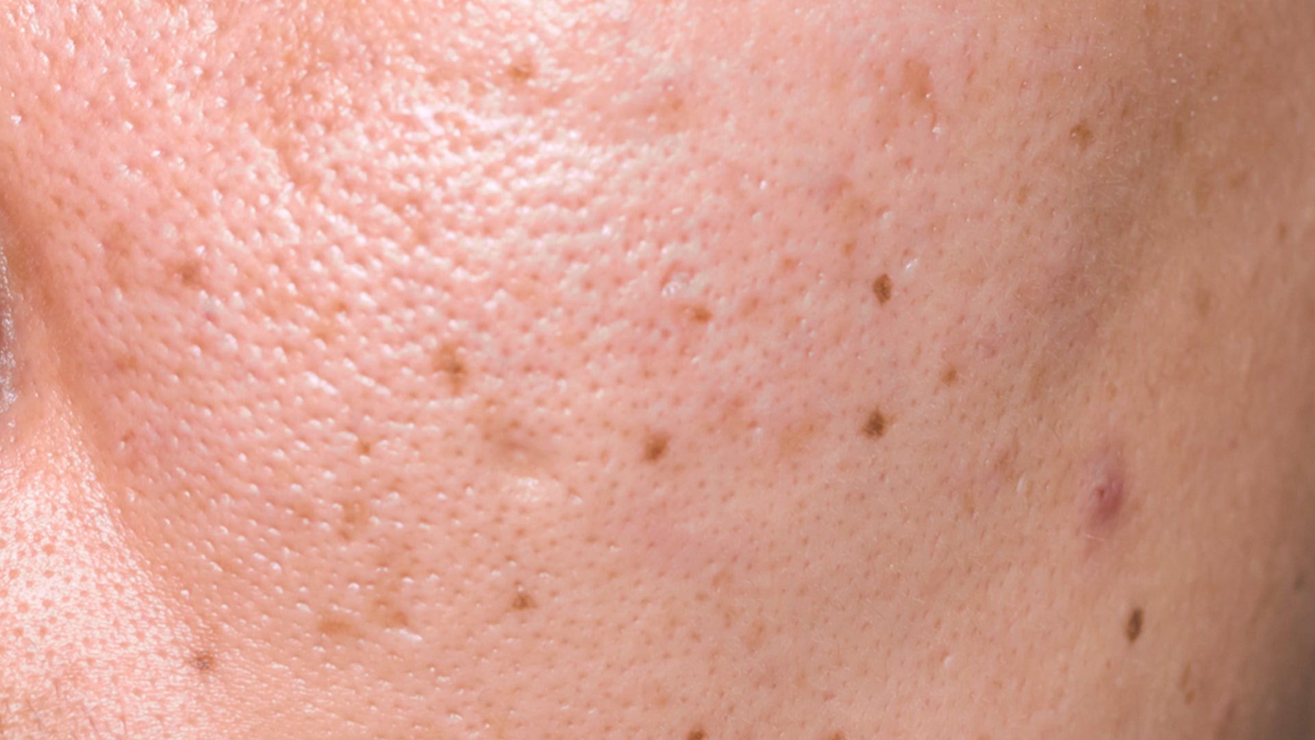 acne dark spots face wash