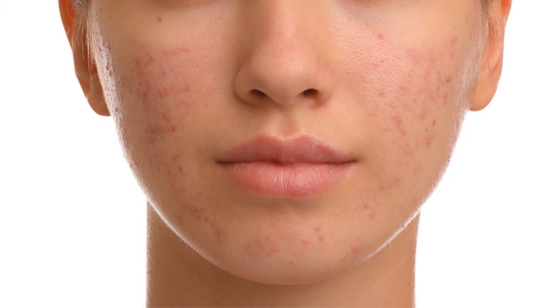 acne issues and acne solutions