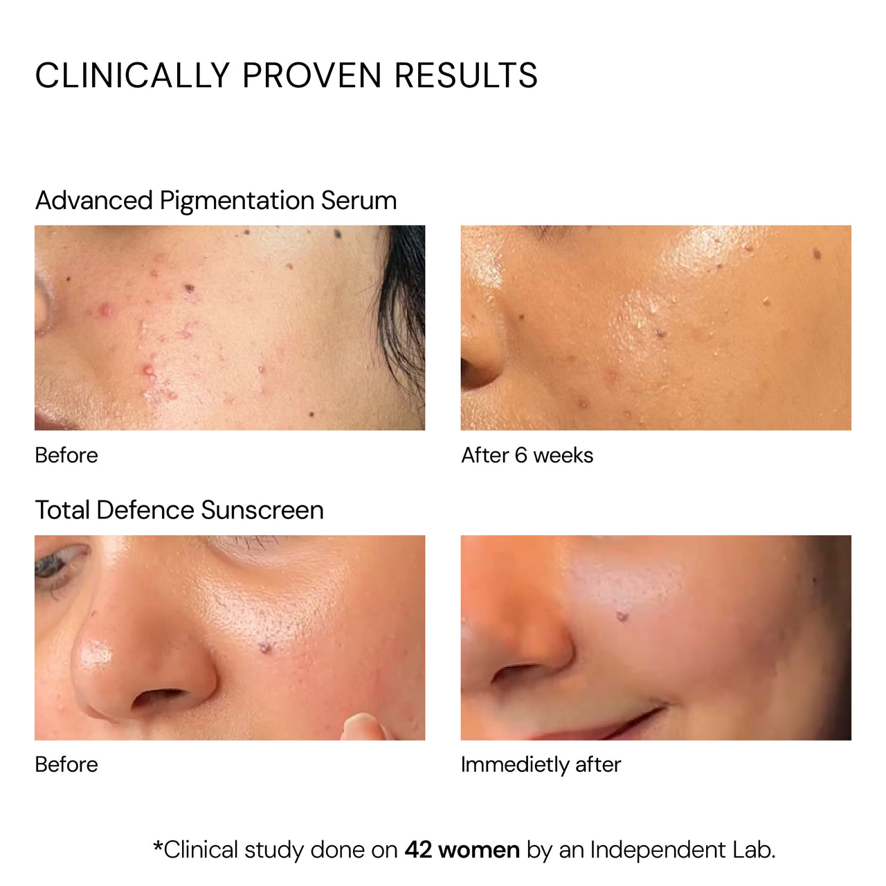 Clinical Pigmentation & SPF Kit ( Acne Safe)