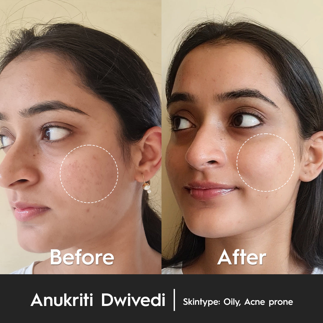 5% Niacinamide Serum - Improves Complexion & Reduces Pigmentation