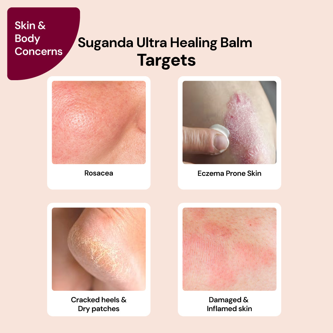 Ultra Healing Eczema Balm