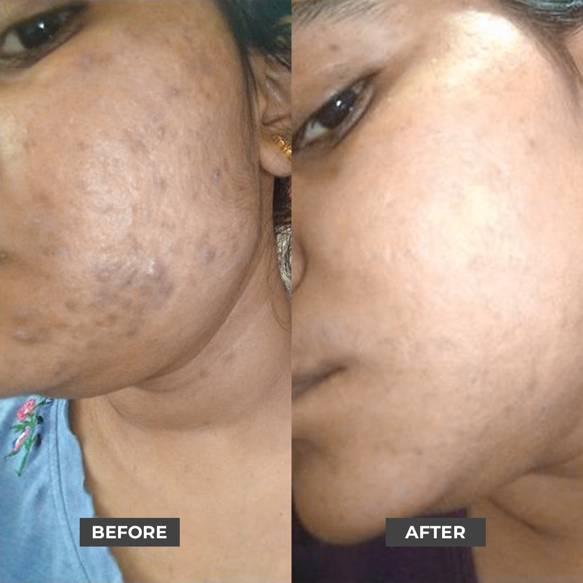 10%Niacinamide Face Serum - Reduces Fades Acne Spots | Acne