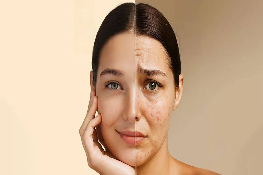 Hyperpigmentation