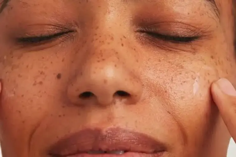 5 Best Ingredients for Hyperpigmentation