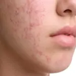 Acne Cause Allergic: Understanding the Link Between Allergies and Acne