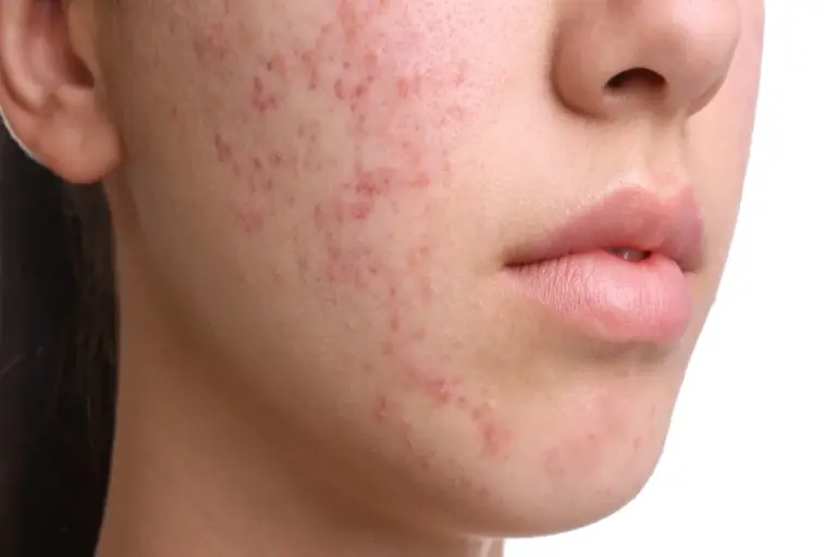 Acne Cause Allergic