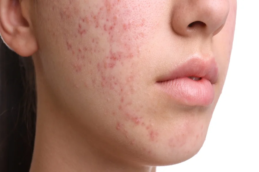 Acne Cause Allergic