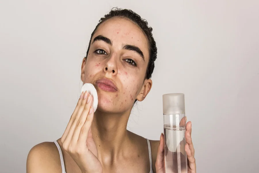 Acne Prone Skin
