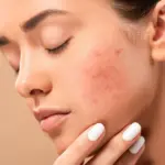 All That You Need To Know About Sensitive Acne Prone Skin