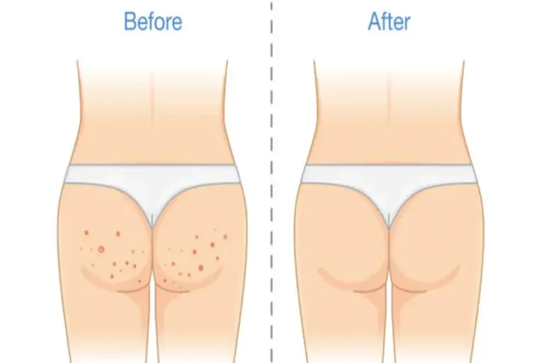Buttock Acne Causes And Treatment Options for Healthier Skin