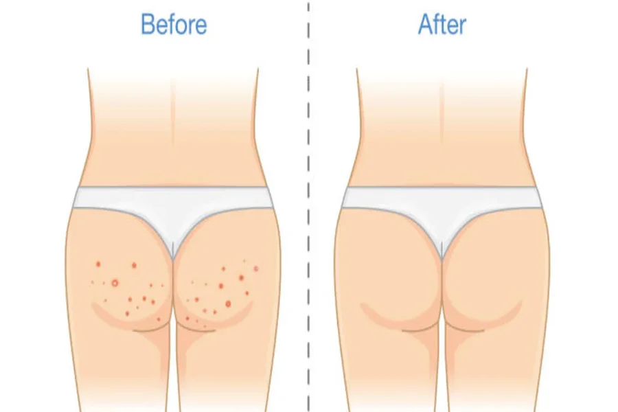 Buttock Acne
