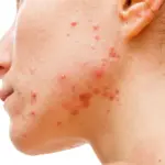 Calm You Angry Irritated Acne In 3 Steps for Healthier Clearer Skin