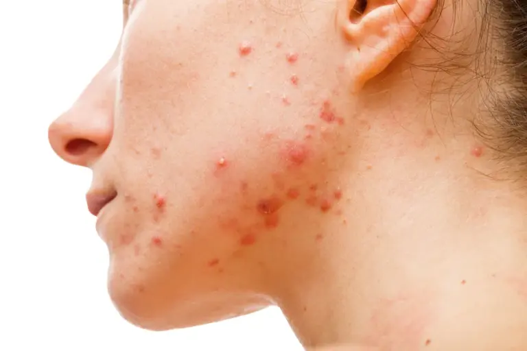 Calm You Angry Irritated Acne In 3 Steps for Healthier Clearer Skin