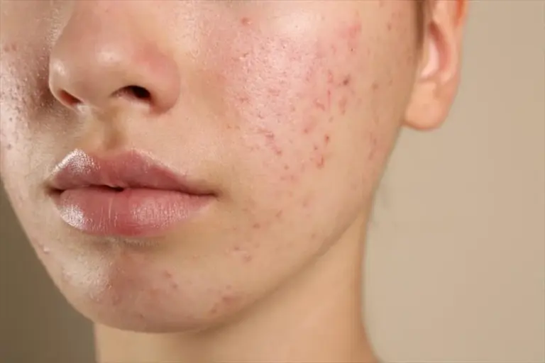 Causes Of Acne: Understanding Why Breakouts Happen and How to Prevent Them