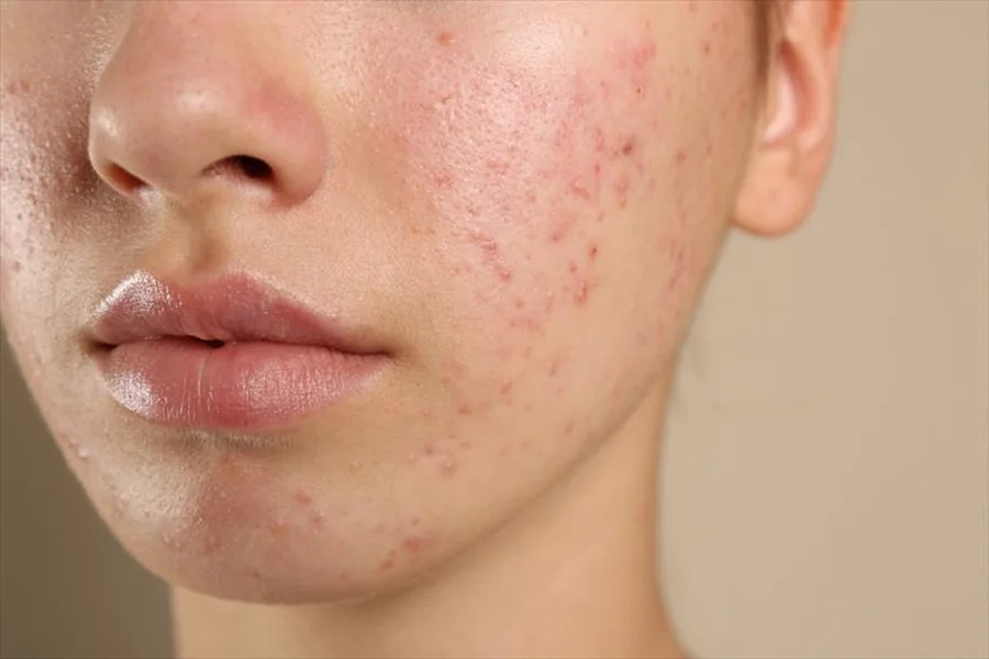 Causes Of Acne