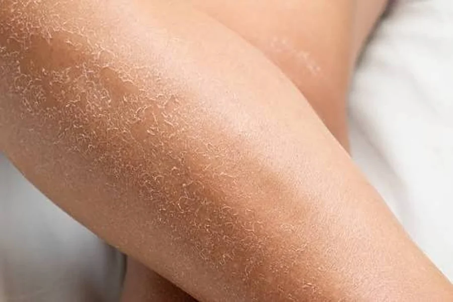 Dry Flaky Skin
